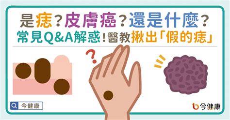 凸痣長毛|是痣？還是皮膚癌？皮膚科醫師教你揪出「假的痣」，。